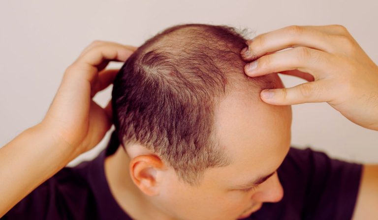 la tête d'n homme qui perd ses cheveux