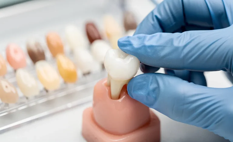 Un dentiste pose délicatement une couronne dentaire en céramique blanche sur une dent modèle, avec des facettes et couronnes disposées en arrière-plan.